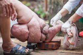 Elephantiasis of the foot.jpg