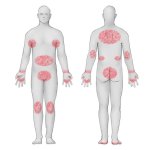 scabies-hot-spots-cutaneous-involvement_.jpg